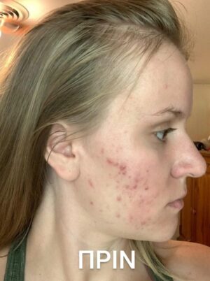 Мехлем при акне и пъпки с пчелен восък 30 мл 8 Мехлем при акне и пъпки с пчелен восък 30 мл - Image 8