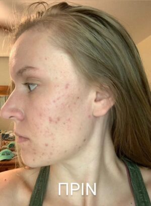 Мехлем при акне и пъпки с пчелен восък 30 мл 7 Мехлем при акне и пъпки с пчелен восък 30 мл - Image 7