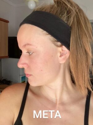 Мехлем при акне и пъпки с пчелен восък 30 мл 9 Мехлем при акне и пъпки с пчелен восък 30 мл - Image 9