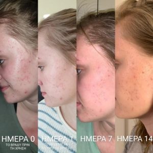 Мехлем при акне и пъпки с пчелен восък 30 мл - Image 12